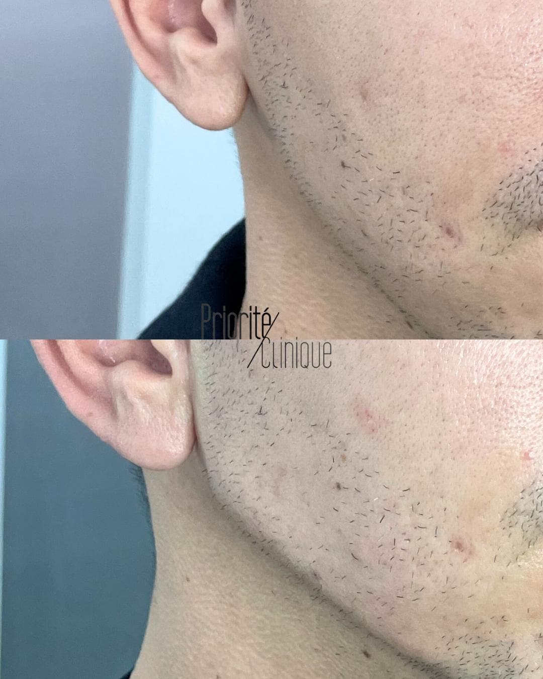 Preenchimento de mandíbula e mento com ácido hialurónico, antes e depois — paciente 1