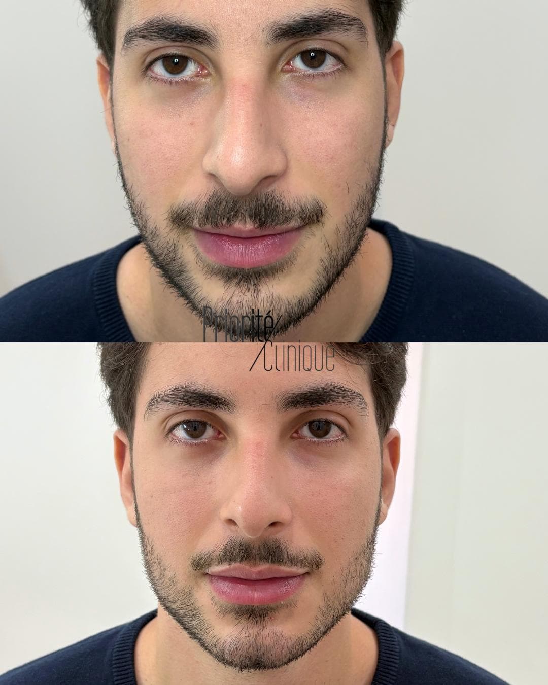 Preenchimento de mandíbula e mento com ácido hialurónico, antes e depois — paciente 10