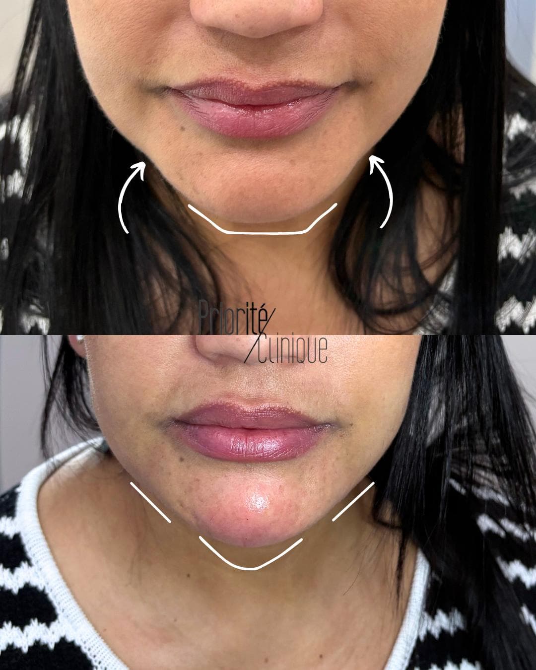 Preenchimento de mandíbula e mento com ácido hialurónico, antes e depois — paciente 11