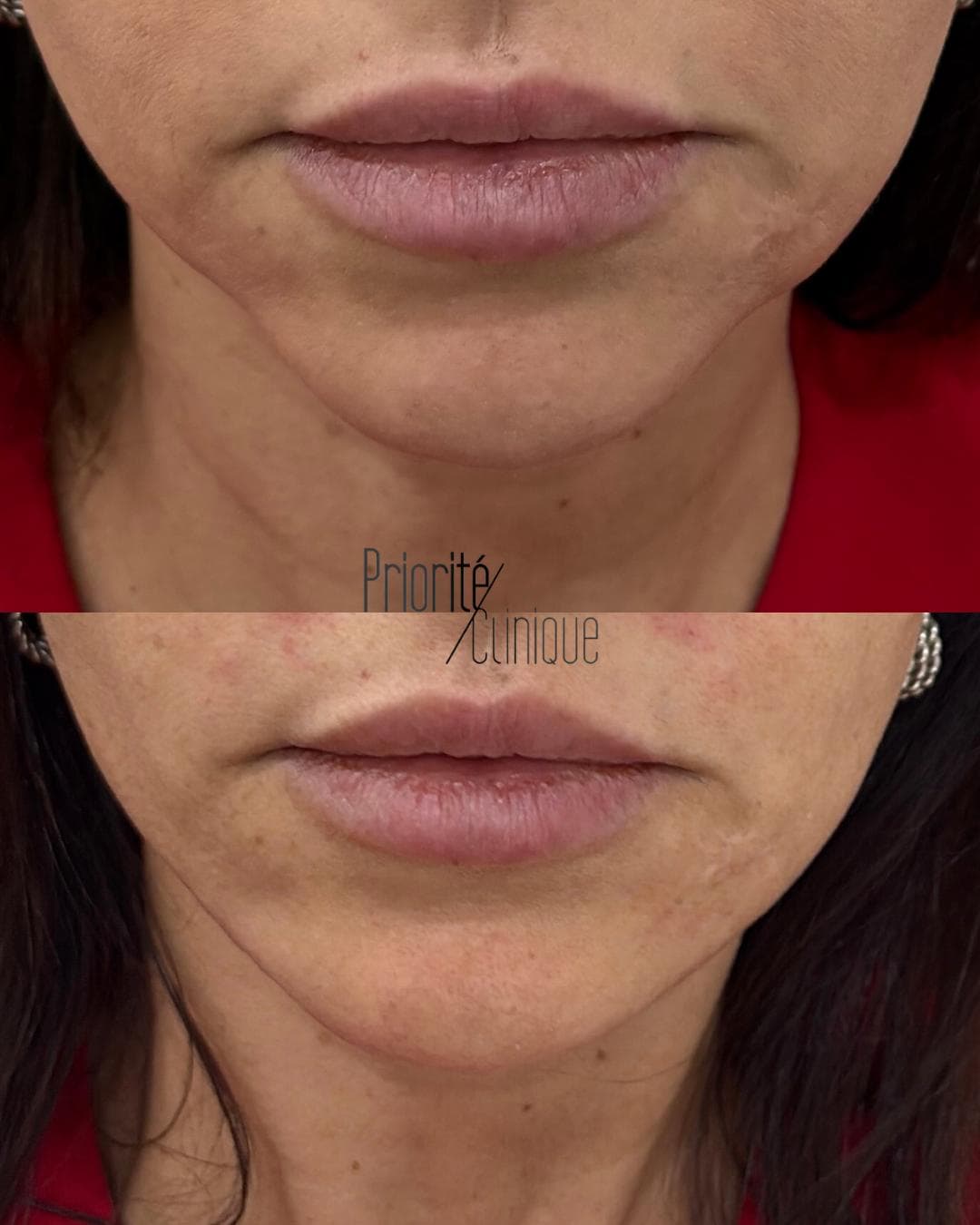 Preenchimento de mandíbula e mento com ácido hialurónico, antes e depois — paciente 12