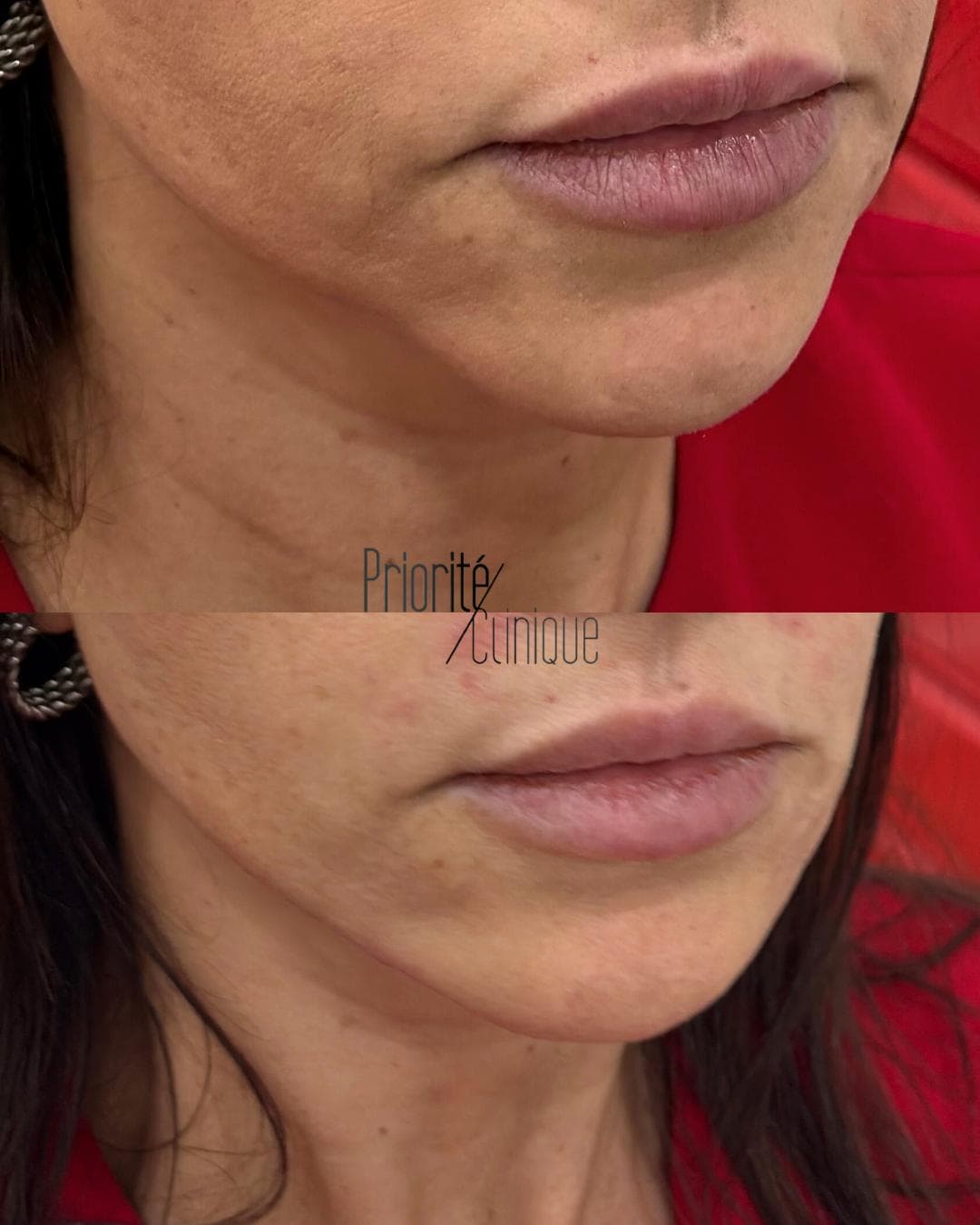 Preenchimento de mandíbula e mento com ácido hialurónico, antes e depois — paciente 13