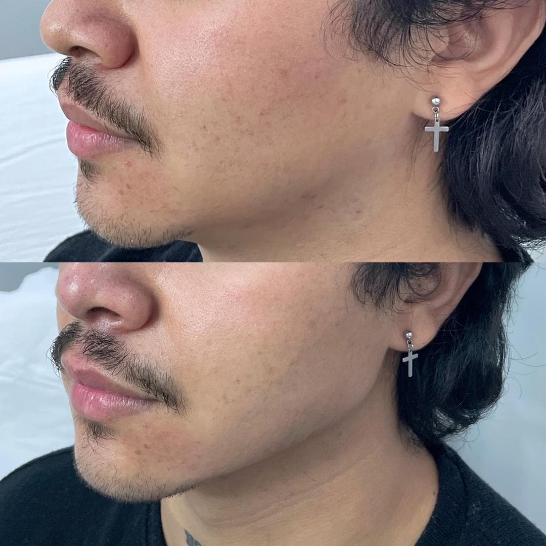 Preenchimento de mandíbula e mento com ácido hialurónico, antes e depois — paciente 14