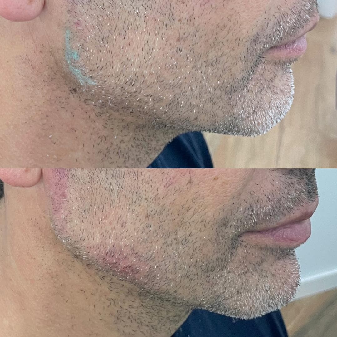 Preenchimento de mandíbula e mento com ácido hialurónico, antes e depois — paciente 15