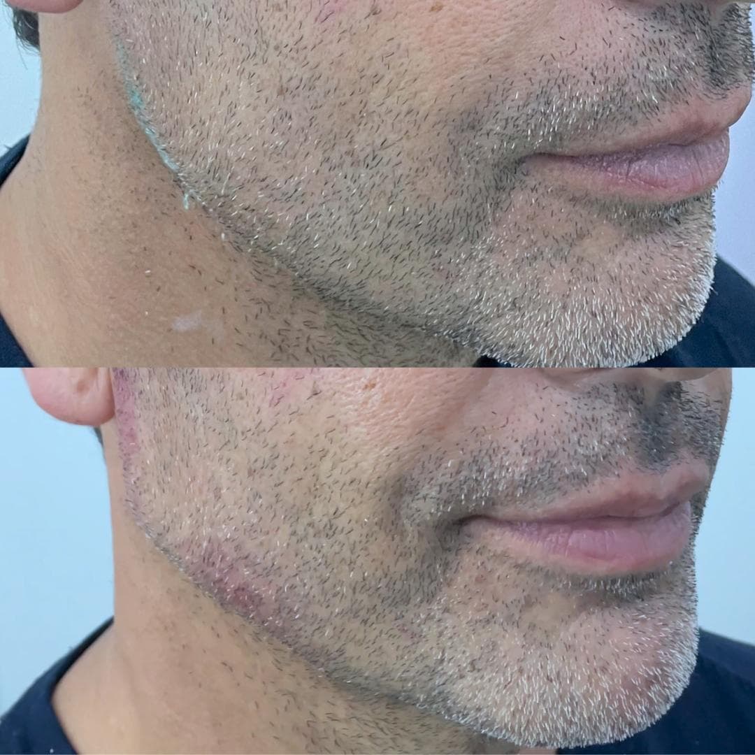 Preenchimento de mandíbula e mento com ácido hialurónico, antes e depois — paciente 16