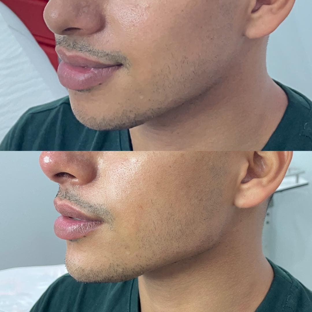 Preenchimento de mandíbula e mento com ácido hialurónico, antes e depois — paciente 17