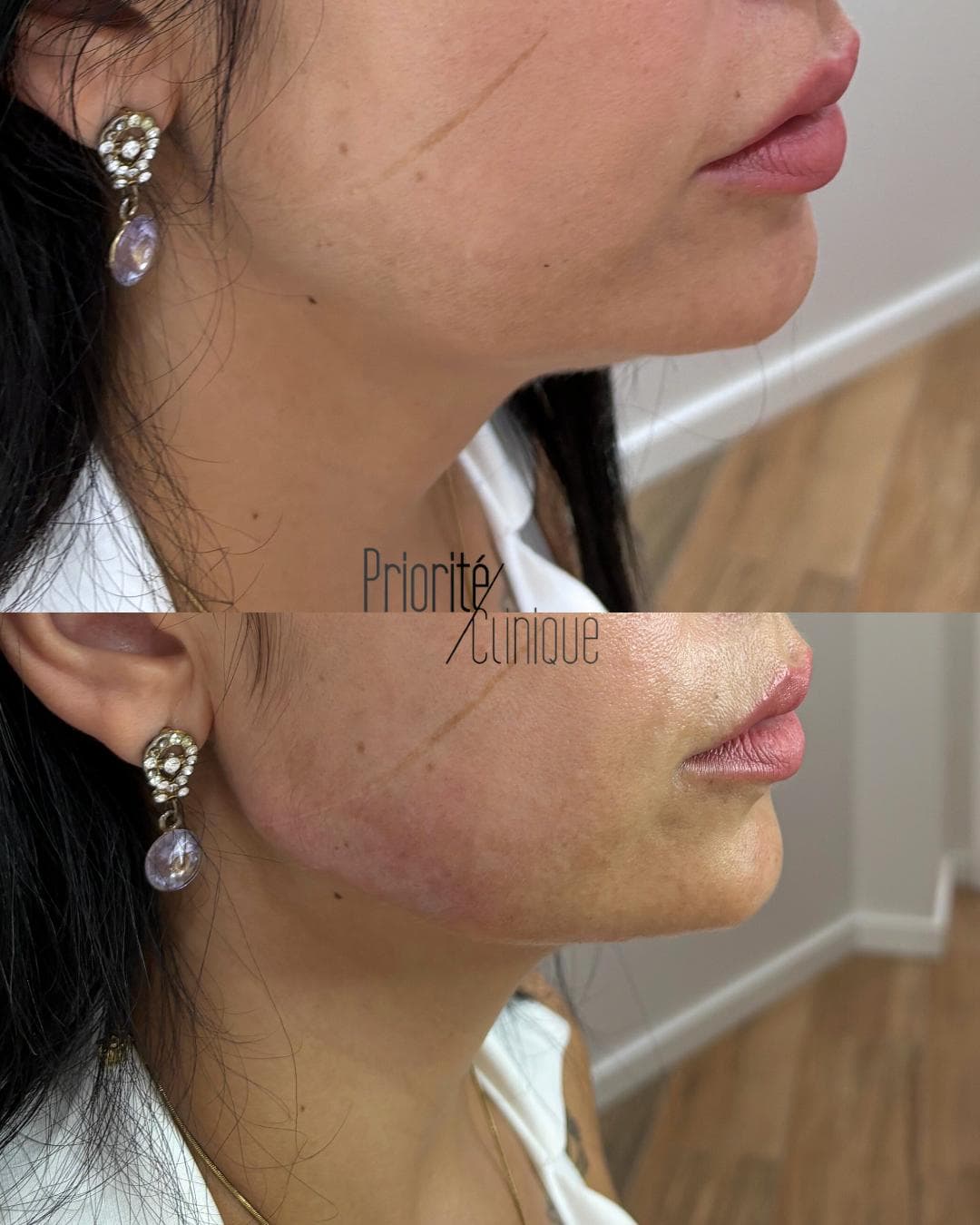 Preenchimento de mandíbula e mento com ácido hialurónico, antes e depois — paciente 18
