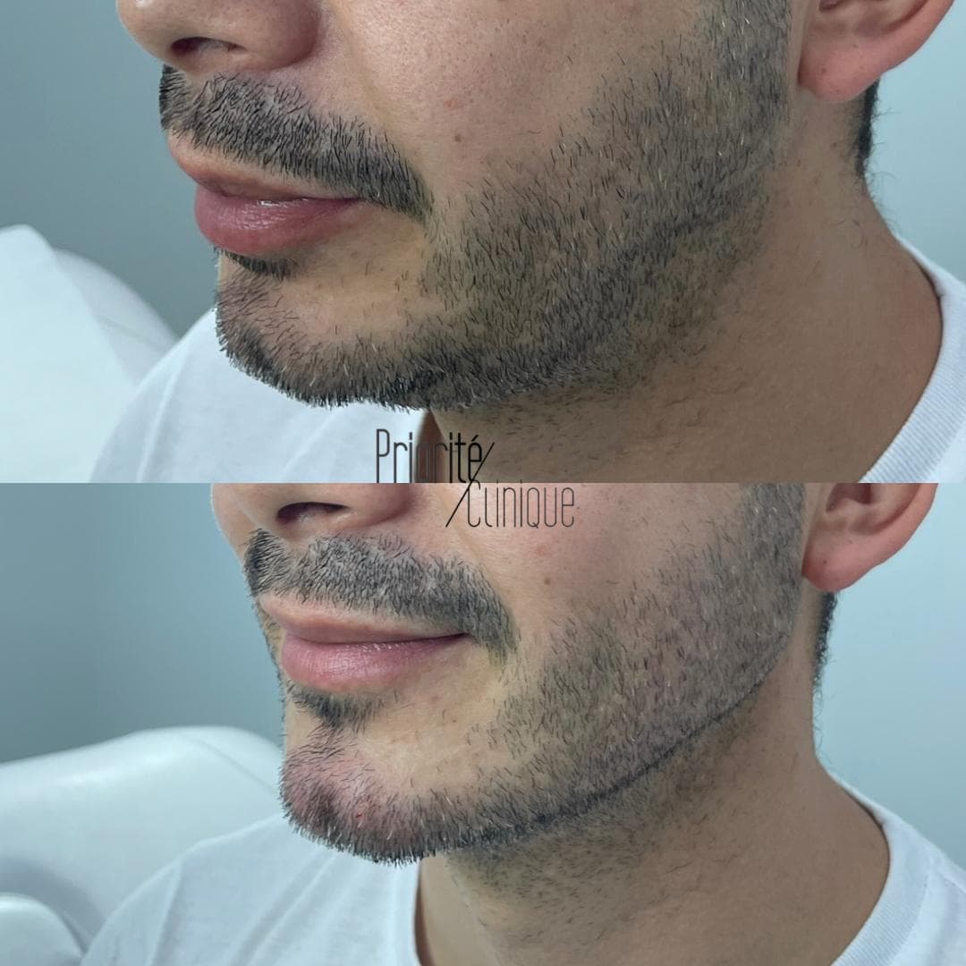 Preenchimento de mandíbula e mento com ácido hialurónico, antes e depois — paciente 19