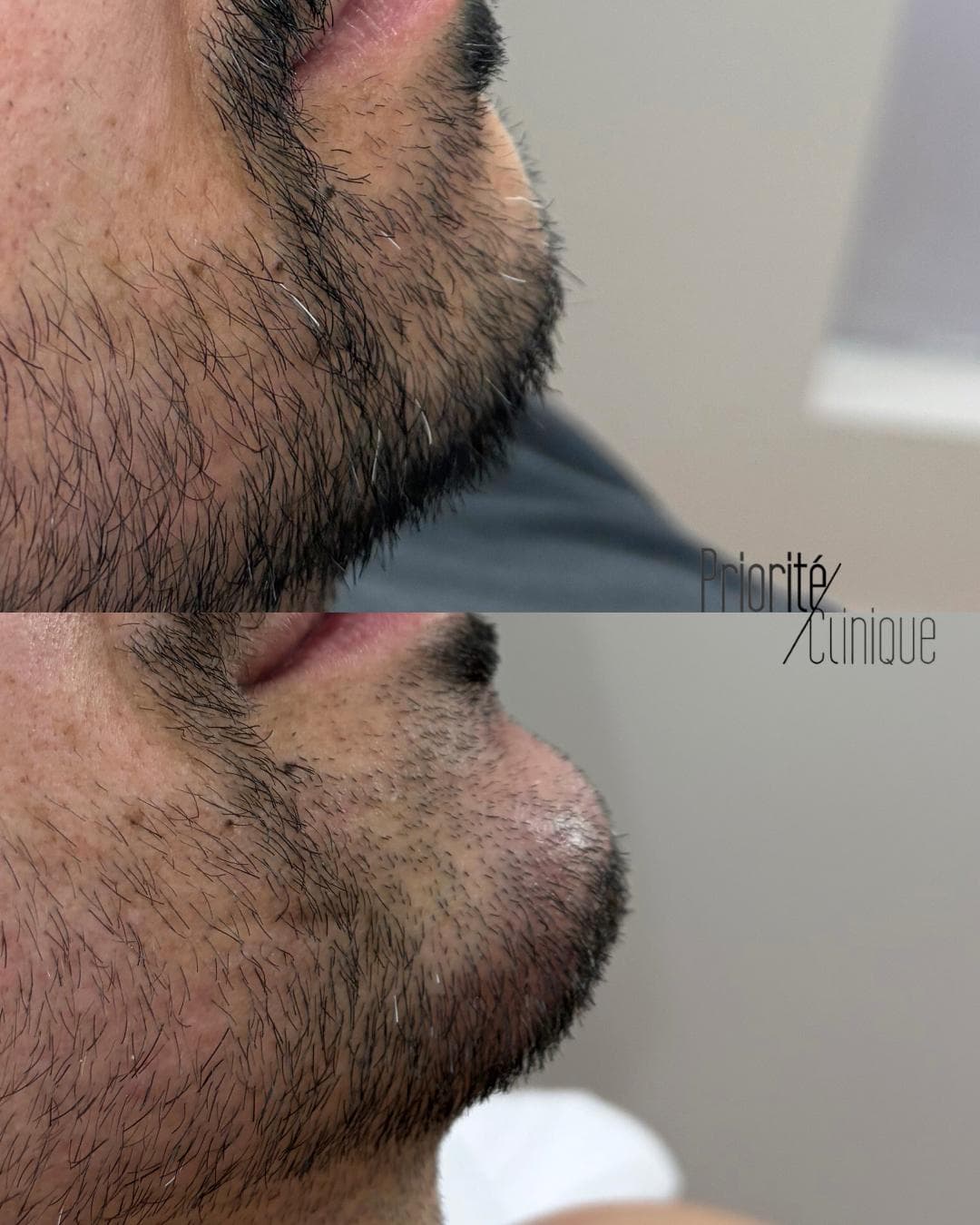 Preenchimento de mandíbula e mento com ácido hialurónico, antes e depois — paciente 2