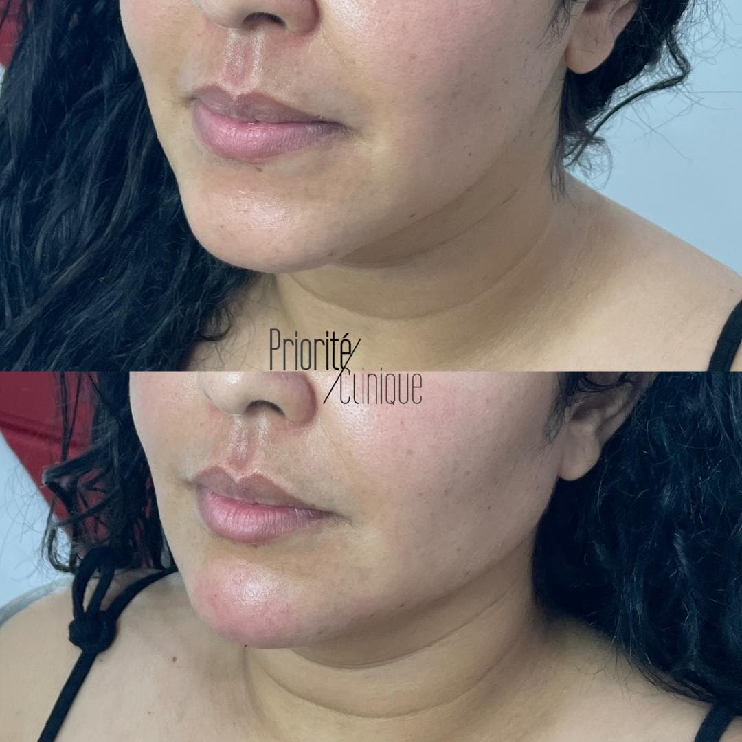 Preenchimento de mandíbula e mento com ácido hialurónico, antes e depois — paciente 20