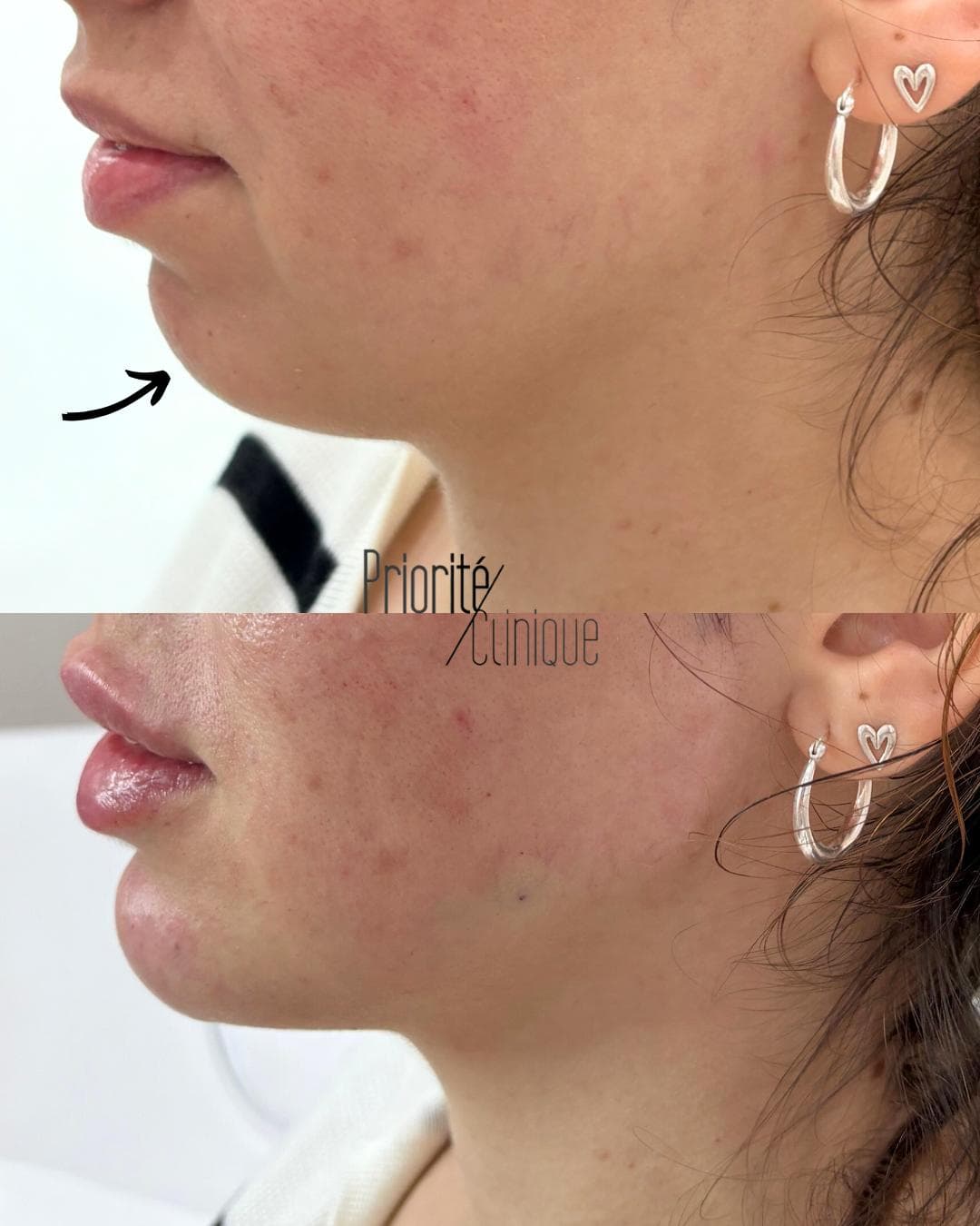 Preenchimento de mandíbula e mento com ácido hialurónico, antes e depois — paciente 3