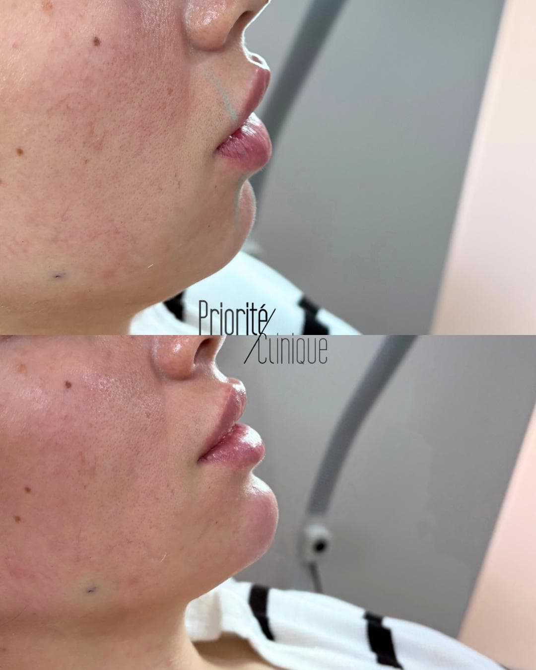 Preenchimento de mandíbula e mento com ácido hialurónico, antes e depois — paciente 4
