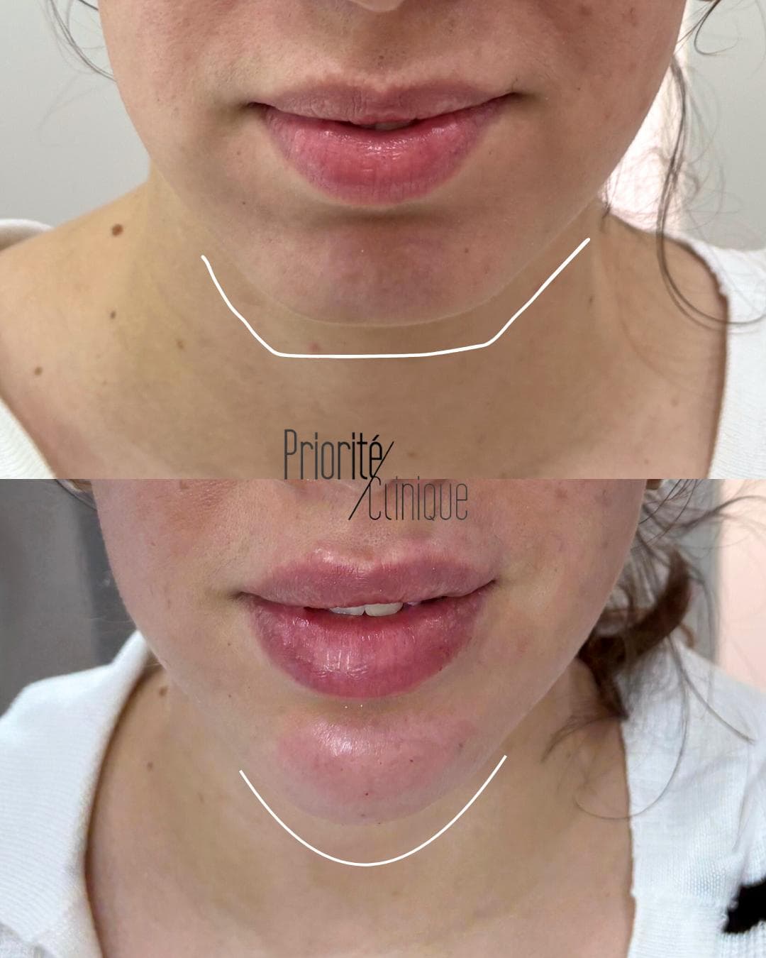 Preenchimento de mandíbula e mento com ácido hialurónico, antes e depois — paciente 5