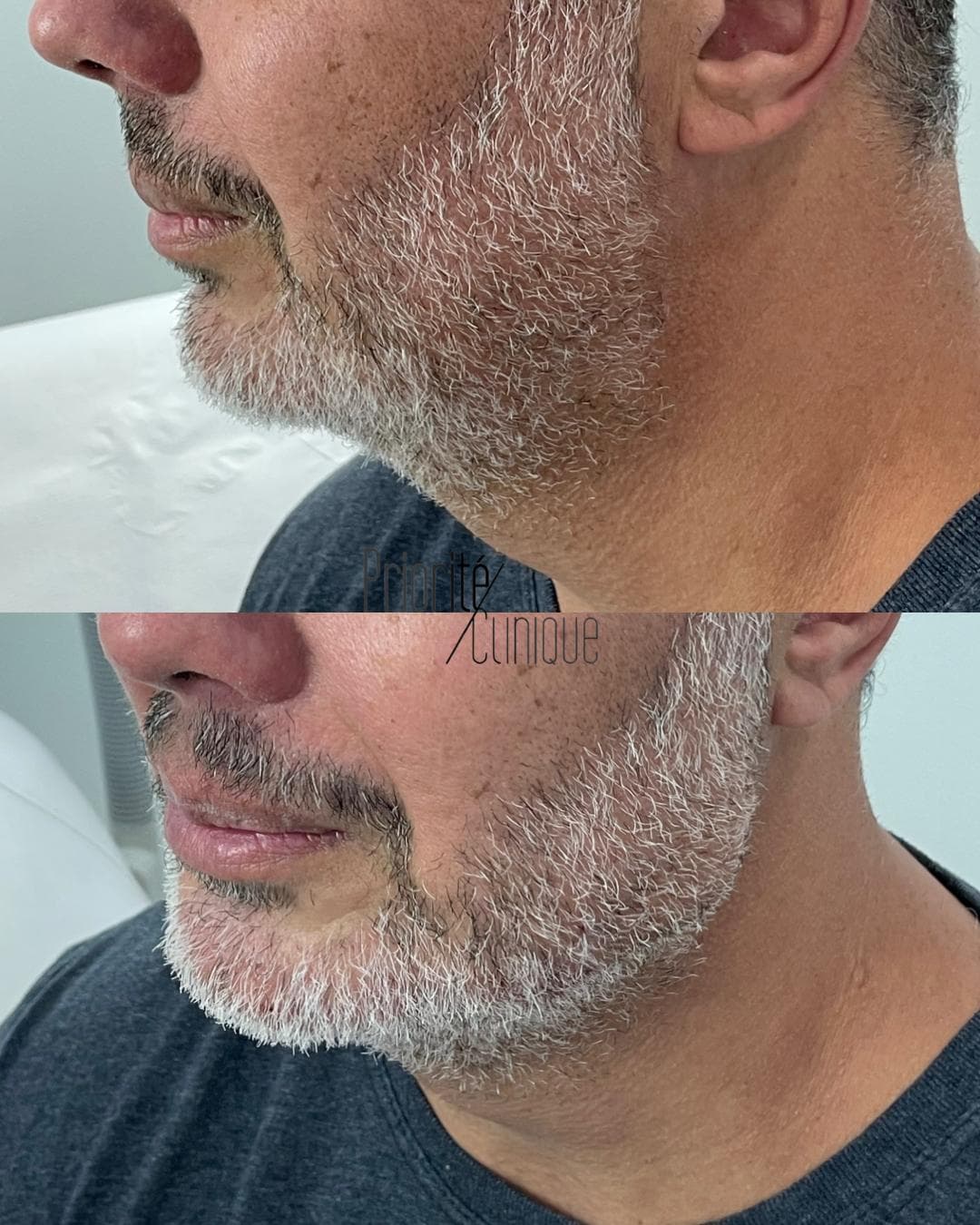 Preenchimento de mandíbula e mento com ácido hialurónico, antes e depois — paciente 6