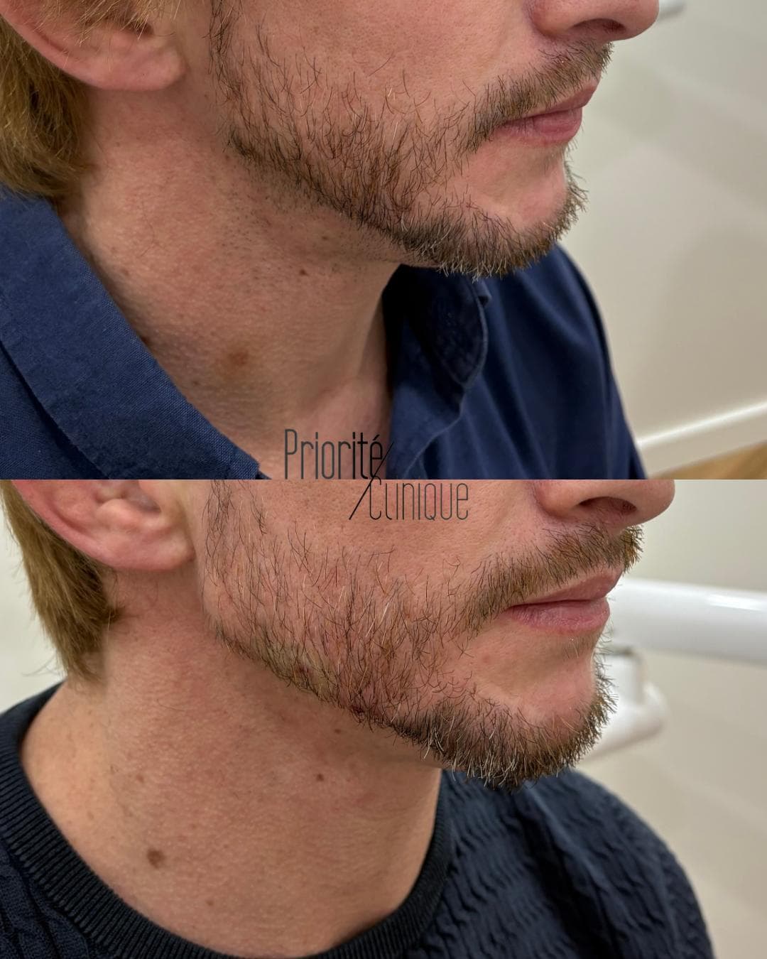 Preenchimento de mandíbula e mento com ácido hialurónico, antes e depois — paciente 7
