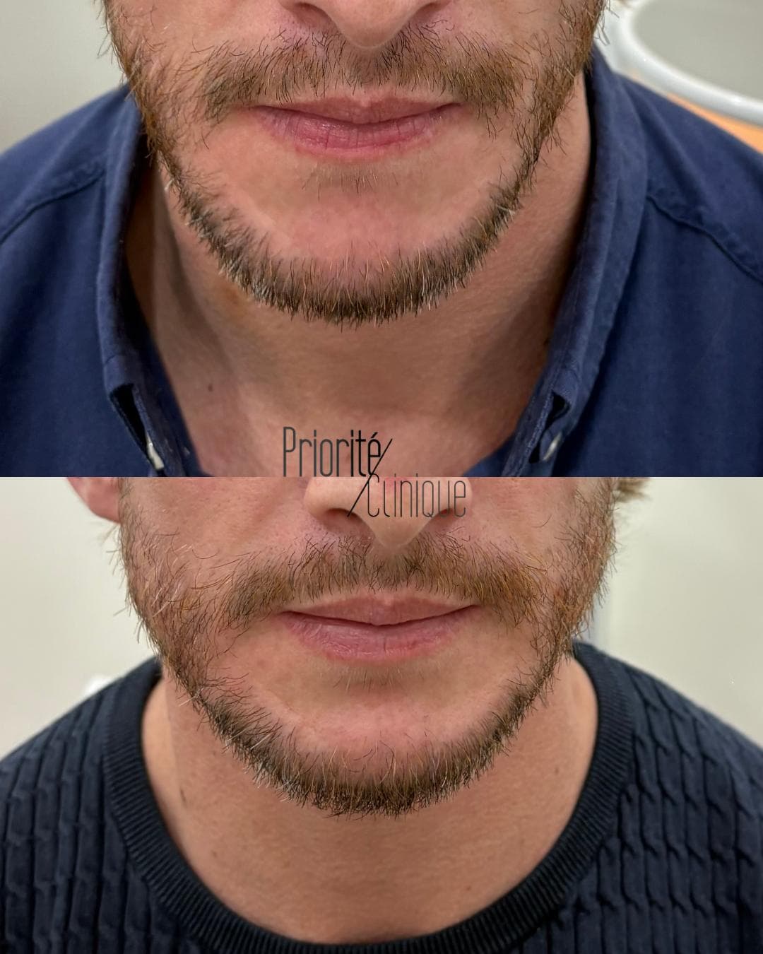 Preenchimento de mandíbula e mento com ácido hialurónico, antes e depois — paciente 8
