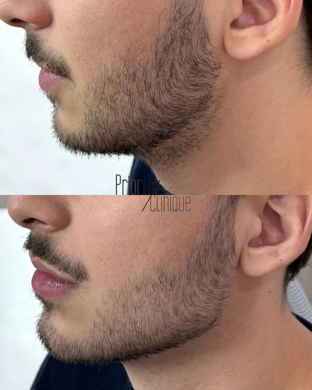 Preenchimento de mandíbula e mento com ácido hialurónico, antes e depois — paciente 9