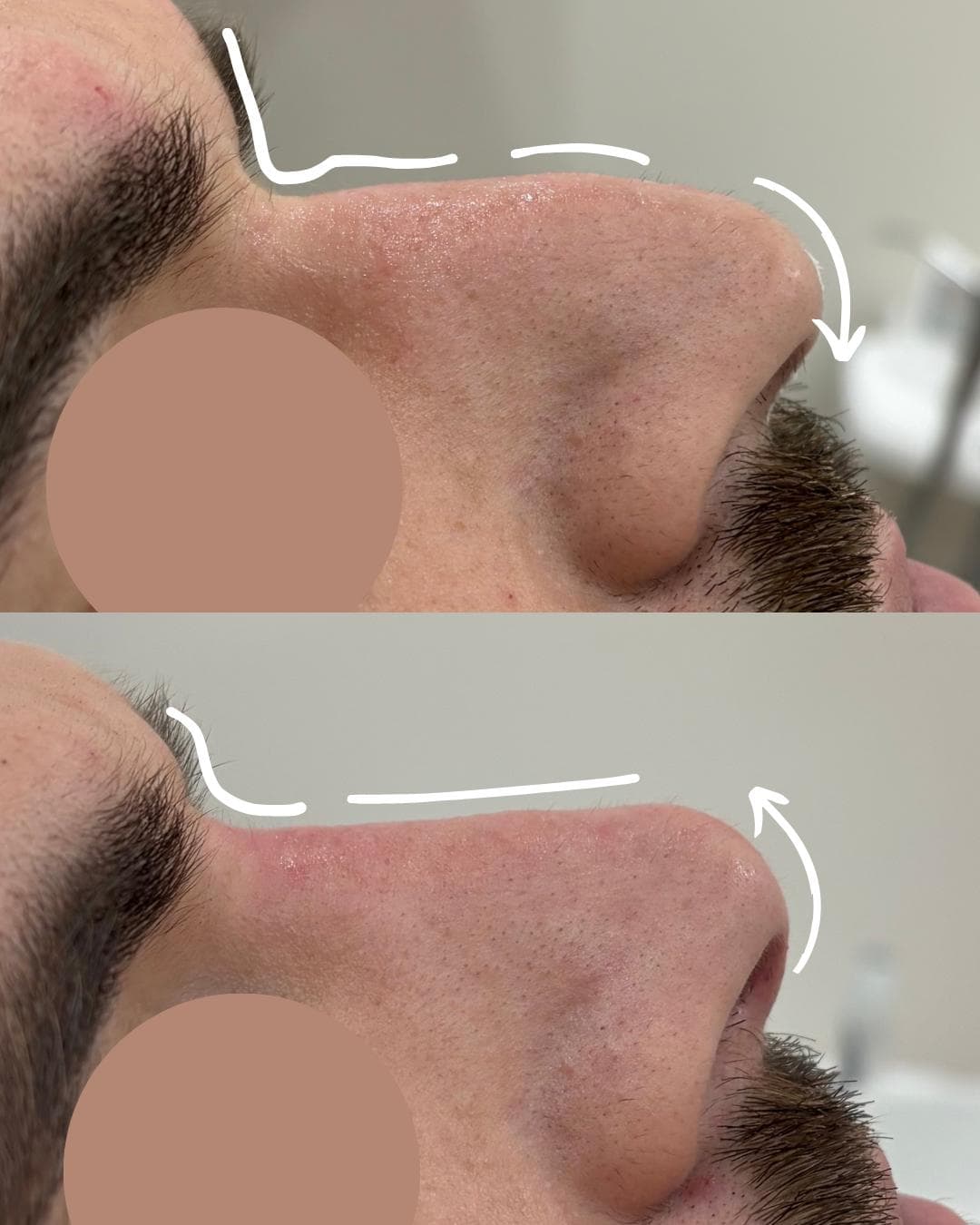 Rinomodelação com ácido hialurónico, antes e depois — paciente 1
