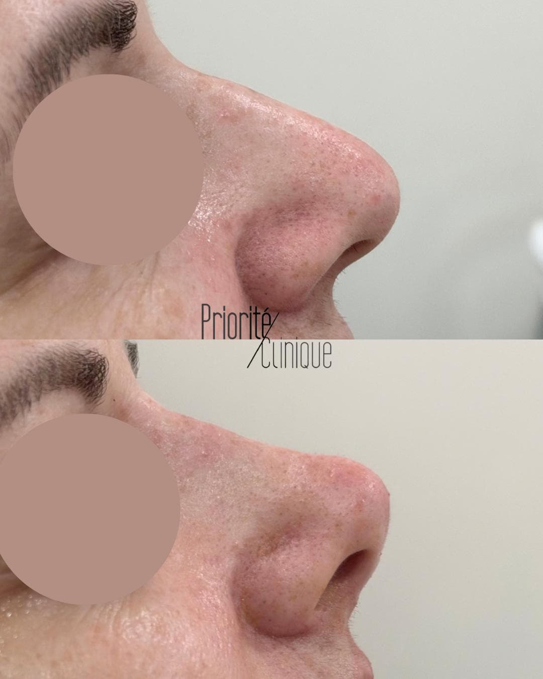 Rinomodelação com ácido hialurónico, antes e depois — paciente 2