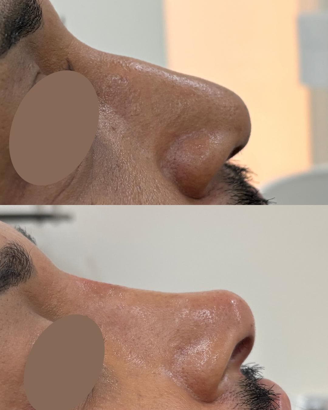 Rinomodelação com ácido hialurónico, antes e depois — paciente 3