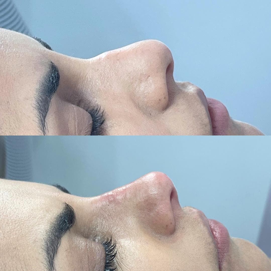 Rinomodelação com ácido hialurónico, antes e depois — paciente 4