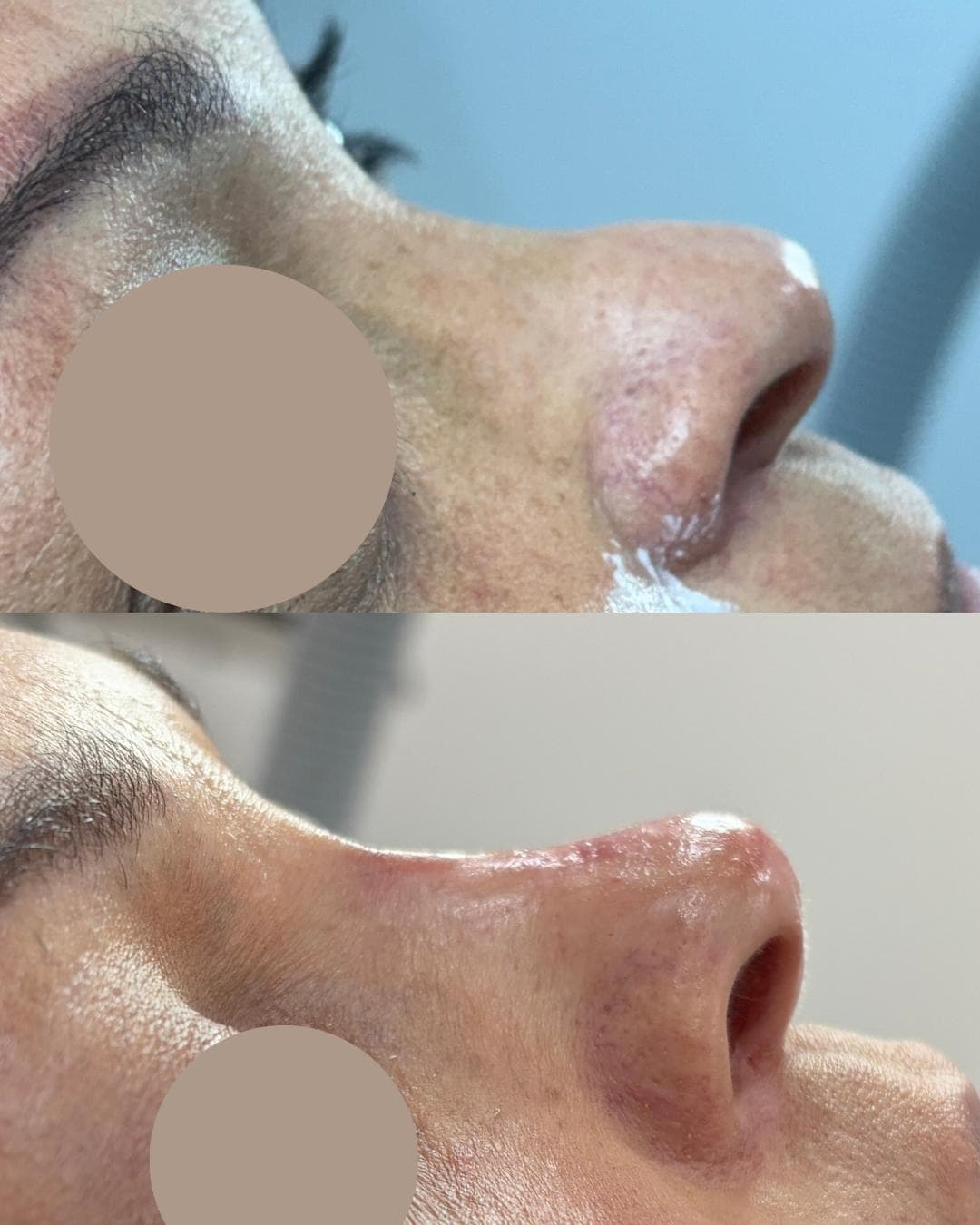 Rinomodelação com ácido hialurónico, antes e depois — paciente 5