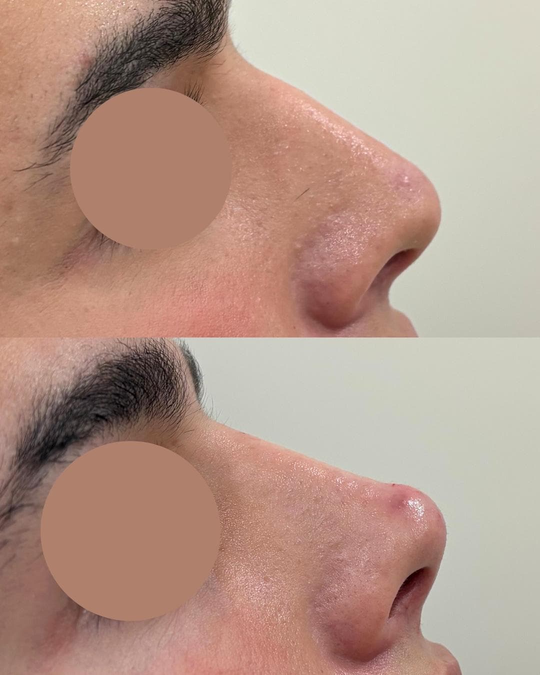 Rinomodelação com ácido hialurónico, antes e depois — paciente 6